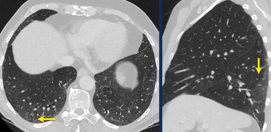 Peripheral, faint groundglass (arrows) in a patient with nonspecific interstitial pneumonia