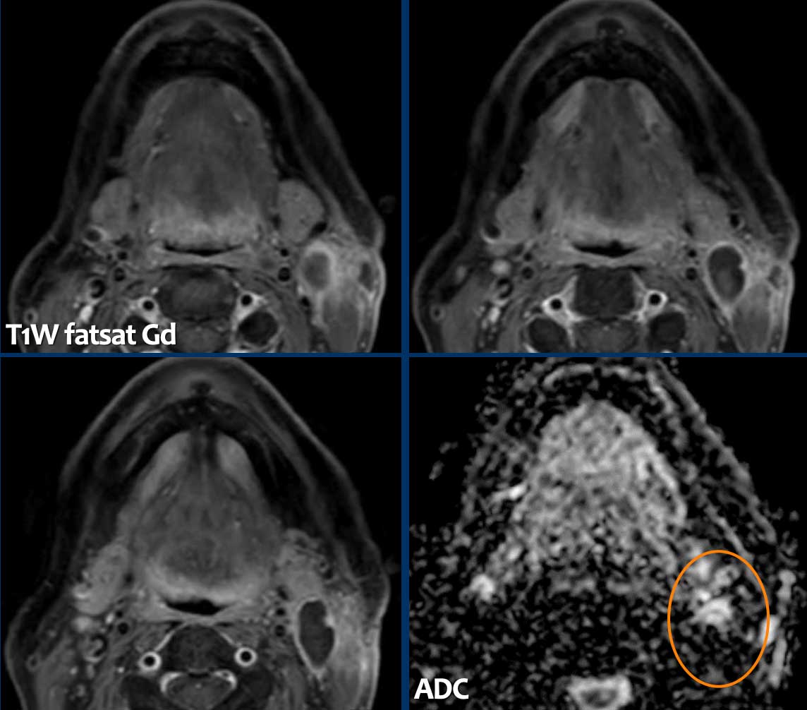 The Radiology Assistant Head Neck Tumors When To Think Of Malignancy