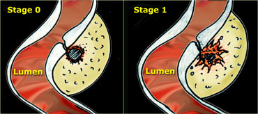 LEFT: The neck of the diverticulum becomes obstructed. Surrounding inflamed fat represents mesentery and omentum attempting to wall-off the imminent perforation.  RIGHT: Development of a small paracolic abscess, successfully walled-off by mesentery and omentum.