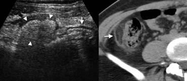 Fig. 7.- 29-year-old woman with epiploic appendagitis. A, Sonography of the right lower quadrant reveals a hyperechoic inflamed fatty mass  (arrowheads) adjacent to the colon (arrow), at the spot of maximum tenderness. B, On unenhanced CT the fatty lesion contains a characteristic hyperattenuating ring (arrow) corresponding to thickened visceral peritoneal lining.