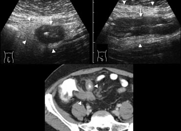 Fig. 11.- 28-year-old man with acute ileocecal Crohn disease.A and B, Sonography shows transmural wall thickening of the terminal ileum (arrows) in longitudinal (A) and transverse (B) section, with hyperechoic inflammatory changes of the surrounding fat (arrowheads).C, Contrast-enhanced CT confirms the wall thickening and luminal narrowing of the terminal and pre-terminal ileum (arrowheads), with regional fat-stranding.