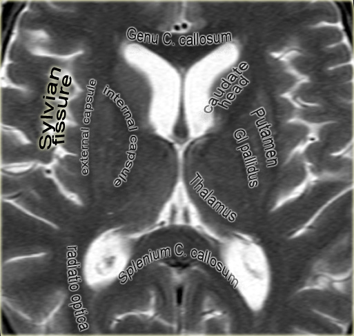 Frontal Lobe Anatomy Mri