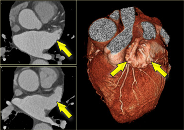 Axial and 3D-reconstructions illustrating the shape and location of the left atrial appendage (yellow arrows).)