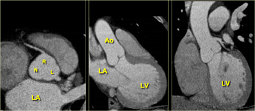 Axial (left) reconstruction, 3-chamber view (middle) and coronal reconstruction (right) of the heart illustrating the relationships between the left atrium, ventricle and aortic root. LA=left atrium, R=right coronary cusp, L=left coronary cusp, N=non-coronary cusp, Ao=aorta, LV=left ventricle