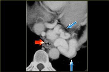 Mediastinal varices (blue arrows) and esophageal varices (red arrow)