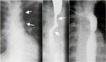 Coarctation: 'Reverse figure 3' indention of esophagus