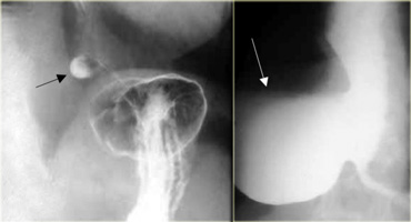 LEFT: Small diverticulum (arrow)  in asymptomatic patient RIGHT: Large diverticulum (arrow)  in patient with aspiration