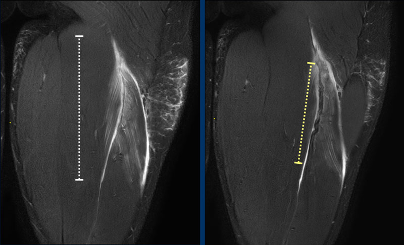 The Radiology Assistant Hamstring Injury