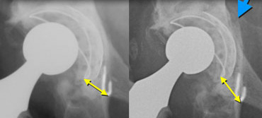 Same case as above with white marks on the tear drop figure. Migration is shown more easily. Blue arrow indicates acetabular fracture.