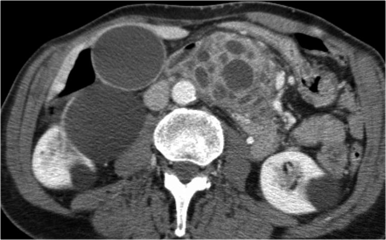 The Radiology Assistant Pancreas Cystic Lesions