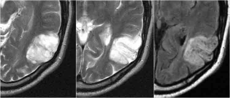 DNET: T2WI and FLAIR show characteristic bubbly appearance  and swelling of affected gyri. Notice scalopping of the skull due to slow growth of the lesion.