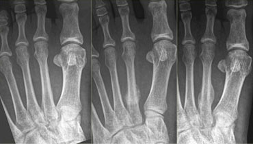 Stress fracture of 2th metatarsal: Radiograph at presentation and at 1 and 3 months follow up.