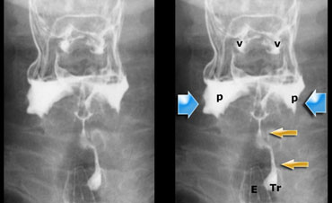 Stasis of contrast at the level of the pyriform sinuses (blue arrows) with subsequent aspiration (yellow arrows)