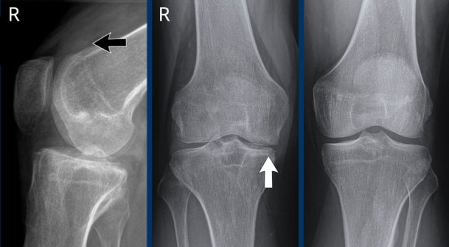Hemophilic arthropathy of the right knee (Arnold-Hilgartner classification: Stage III)