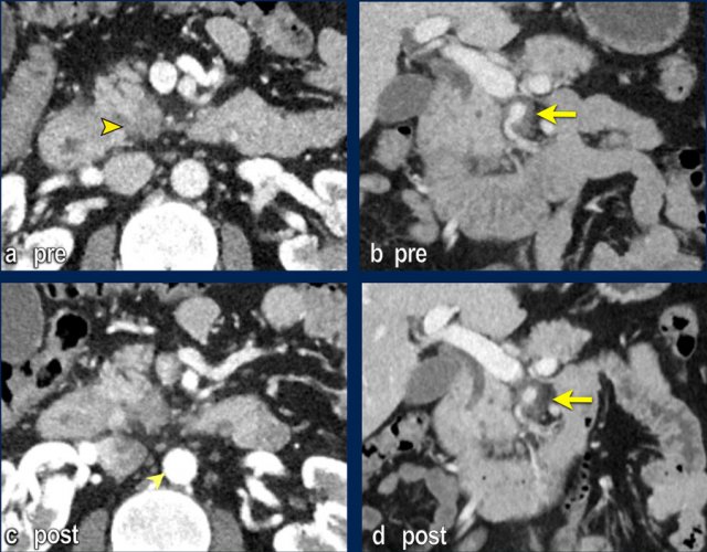 Follow-up CT after neoadjuvant therapy shows no disease progression and exploration was performed.