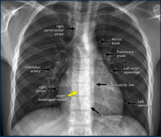Normal Chest Xray Labeled
