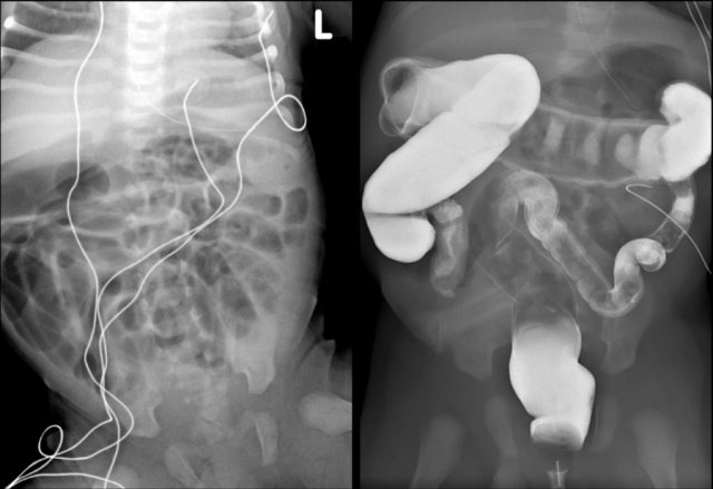 Meconiumplugsyndrome: normal rectum and a small diameter to the left colon. Because the child has a functionally normal rectum he continued to evacuate the contrast and a balloon catheter had to be used.