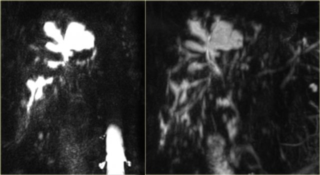 Saccular intrahepatic duct dilatation with normal sized choledochal duct in Caroli disease
