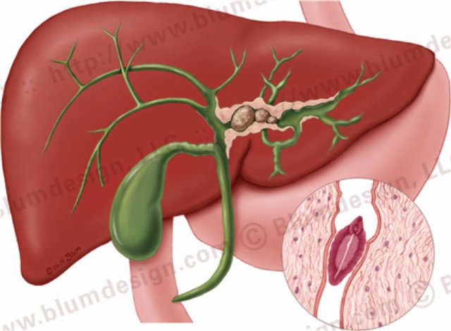 Recurrent pyogenic cholangitis. Illustration by Heike Blum.