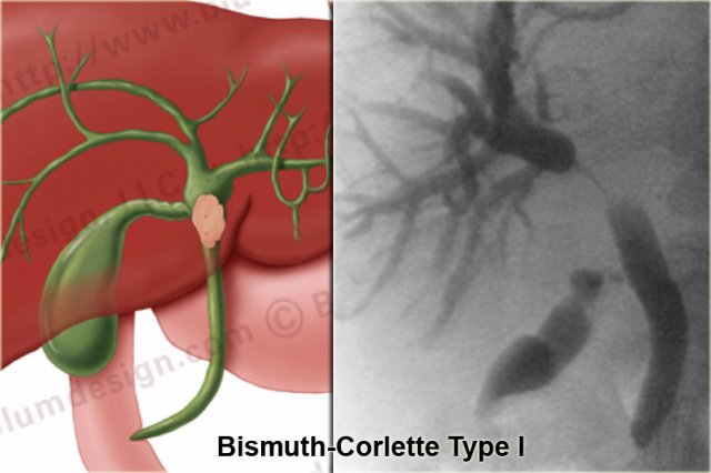 Bismuth-Corlette type I tumor with abrupt stricture and shouldering below the confluens