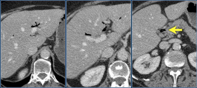 Pneumobilia: air in the intrahepatic bile ducts and in the common  bile duct (arrow).