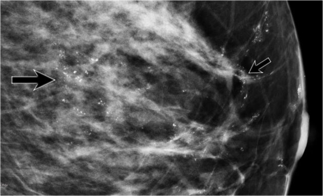 There are multiple fine, linear calcifications in a large segment of the breast. These are suspicious calcifications and are typically seen in DCIS. Click to enlarge