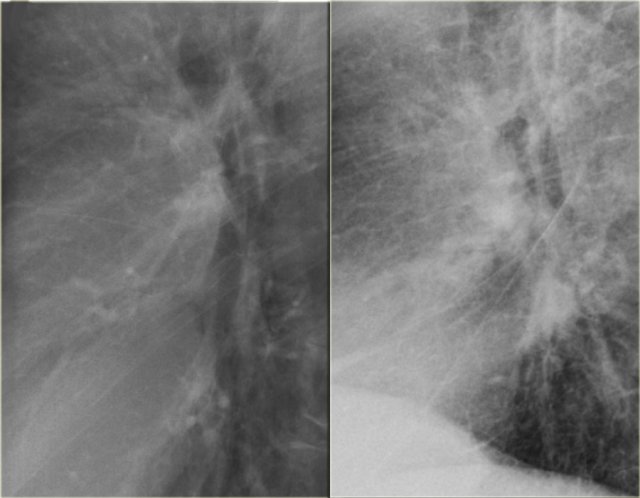 Previous normal chest x-ray (left) and CHF stage II with perihilar haze (right)