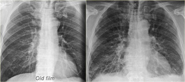 Old film for comparison (left) CHF with redistribution, interstitial edema and some pleural fluid