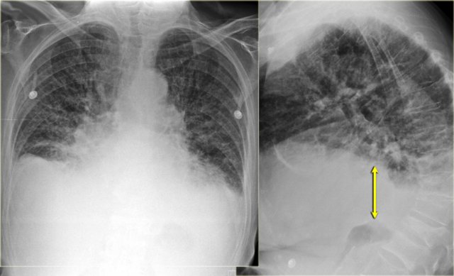 Subpulmonic pleural effusion with increased distance of the stomach air bubble to the lung base (arrow)