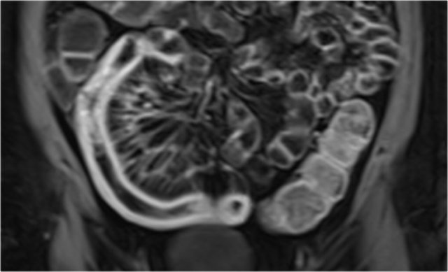 Coronal post-contrast T1 image shows marked enhancement of the terminal ileum with a prominent comb sign.