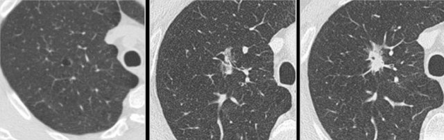 Example showing transition from cystic (left and middle panel) to part-solid lung cancer morphology (right panel).