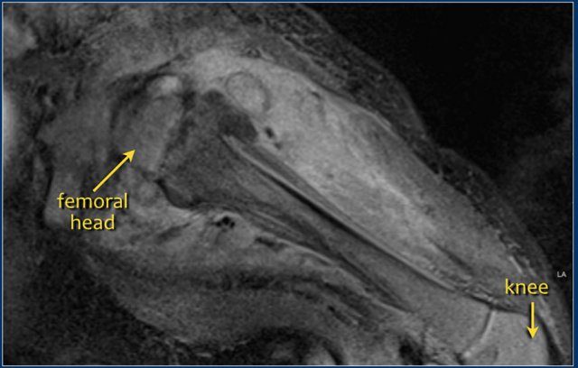 5 week old, sick infant with severe osteomyelitis of the left hip.  MRI with Gadolinium contrast shows extensive soft tissue involvement and periosteal reaction.