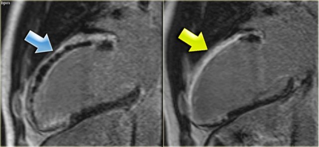 Left: no-reflow phenomenonRight: four months later there is transmural enhancement indicating a transmural infarction