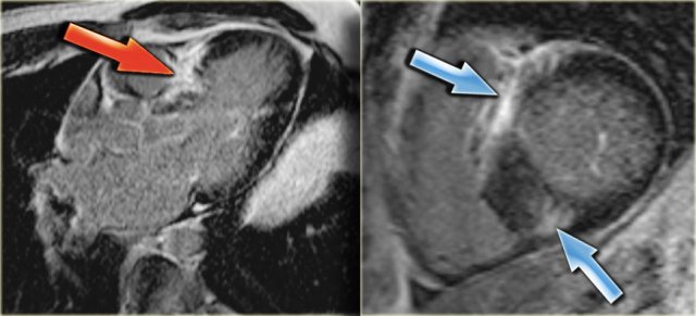 Left: 3-chamber late enhancement image shows the enhancement of the hypertrophic basal septum (arrow)