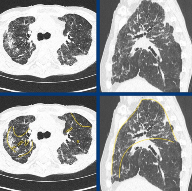 Fibrotic sarcoidosis with peribronchovascular and apical dominant disease