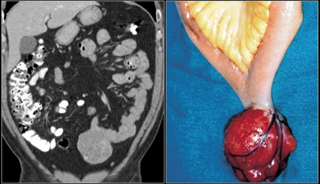  Typical GIST in the ileum presenting as an exophytic tumor.