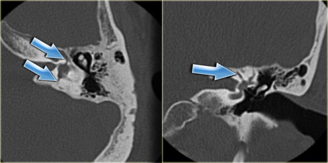 Transverse fracture through vestibule and facial nerve canal (arrows)