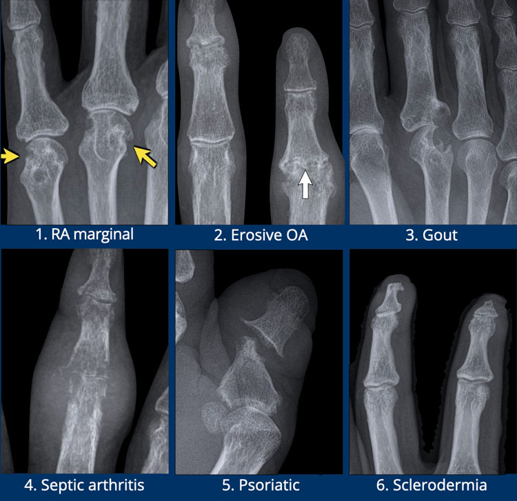 The Radiology Assistant : Arthritis