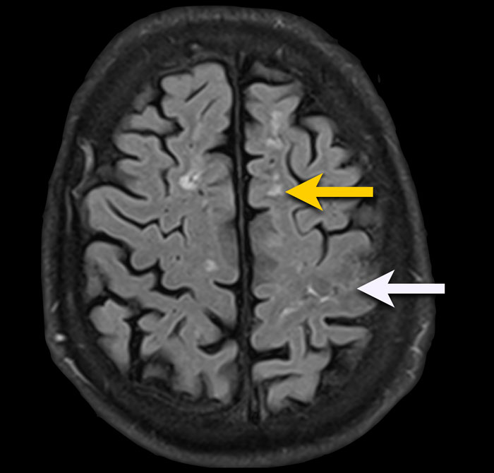 Subarachnoid hemorrhage MRI - Questions and Answers ​in MRI