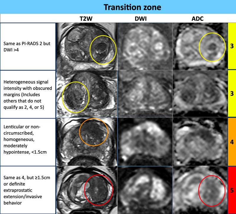 The Radiology Assistant : Prostate Cancer - PI-RADS v2.1