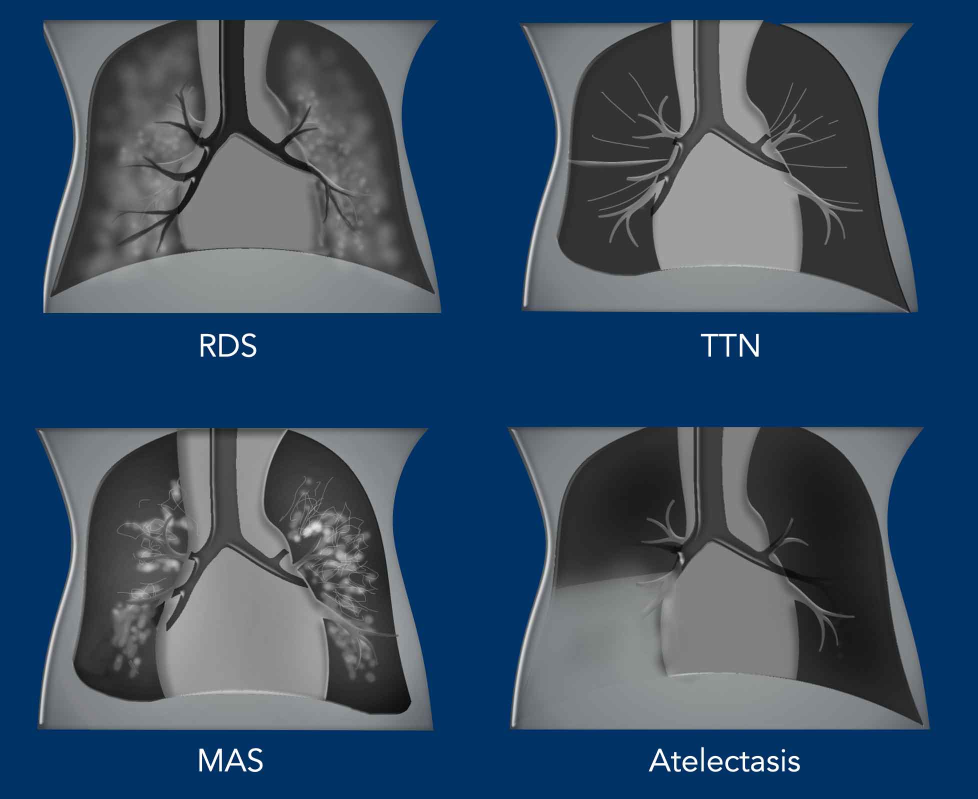 The Radiology Assistant Neonatal Chest XRay