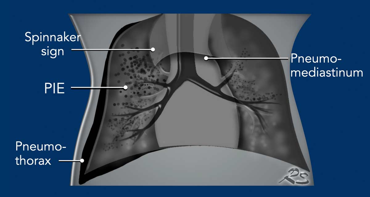 Spinacker Sign The Radiology Assistant : Neonatal Chest X-Ray