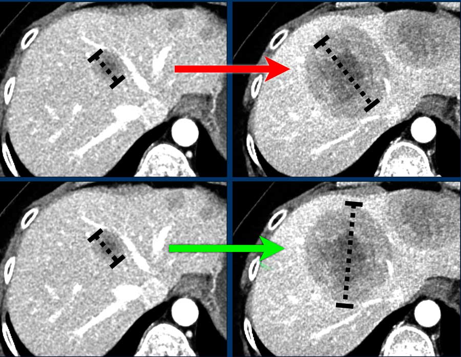 The orientation of the liver metastasis has changed during follow up.