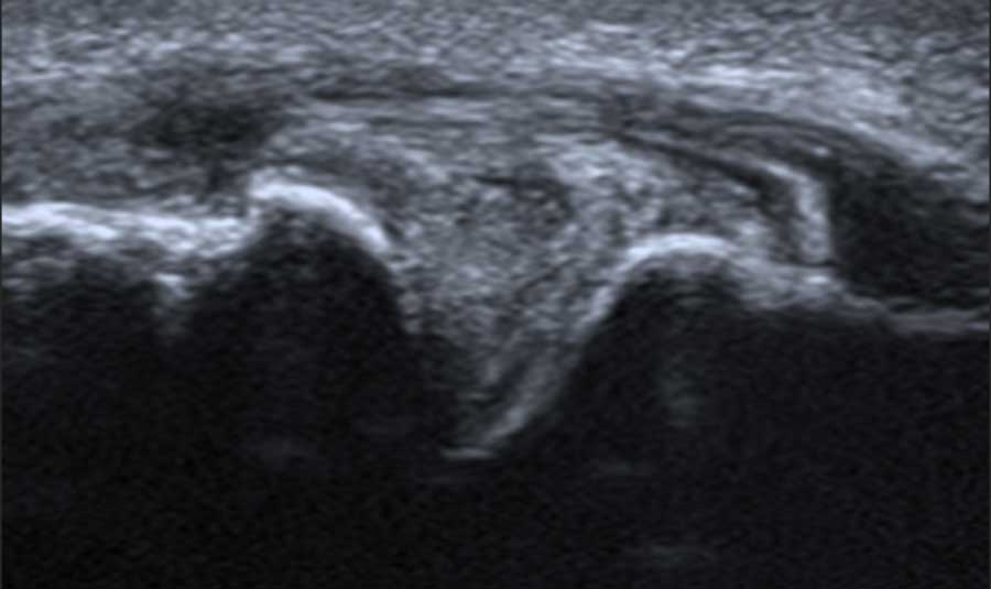 Post-traumatic arthritis of the AC-joint