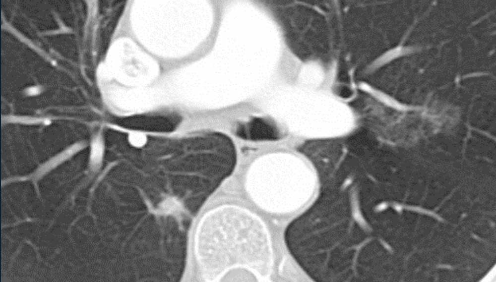 Lung Adenocarcinoma