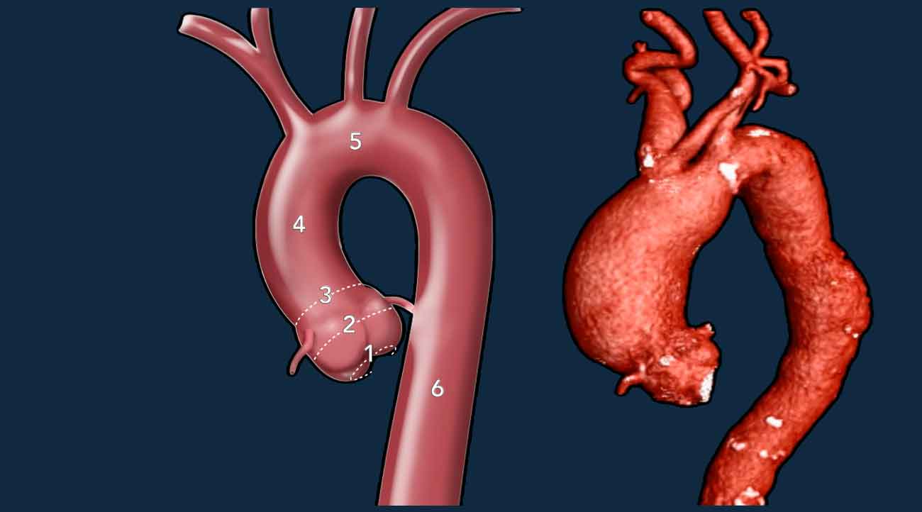 Thoracic Aorta - Chronic dilatation