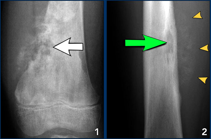 Osteosarcoma (left) and Ewings sarcoma (right)