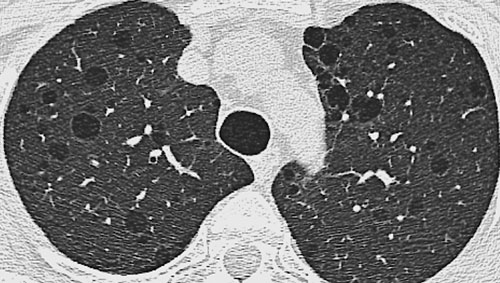 Cystic Lung Disease - Differential diagnosis