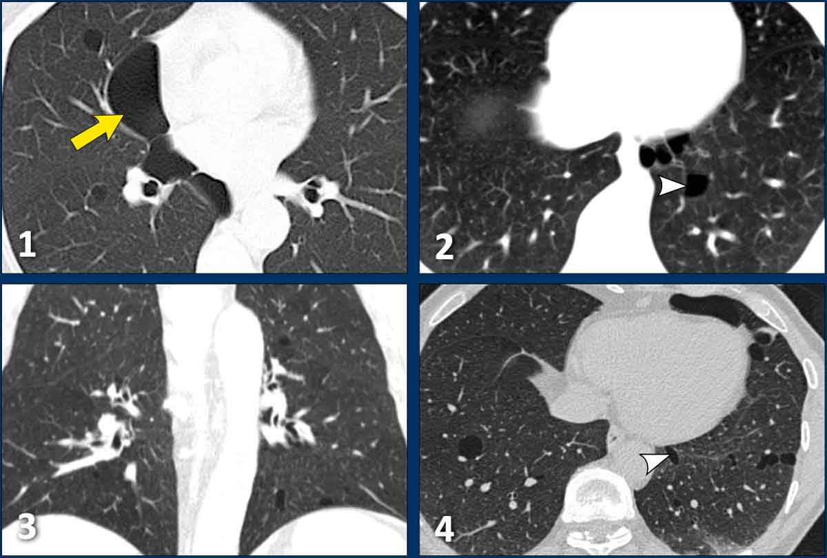 Examples of Birt-Hogg-Dubé syndrome