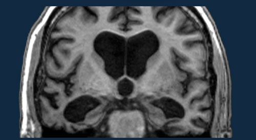 Dementia - Role of MRI